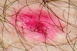 The Best Practical Treatment for Eczema